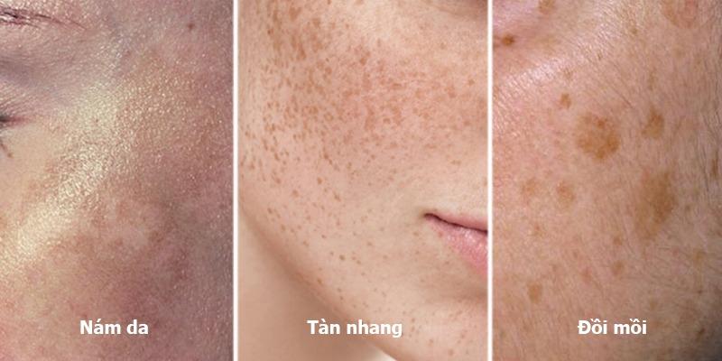 Điều trị Nám – Tàn nhang – Đồi mồi