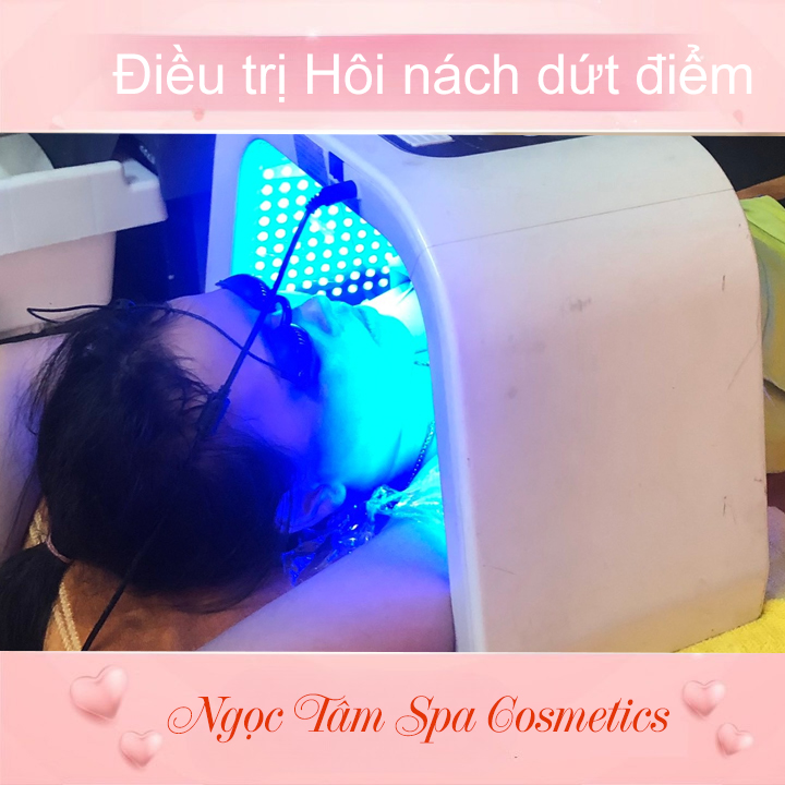 Điều-trị-Hôi-nách-dứt-điểm
