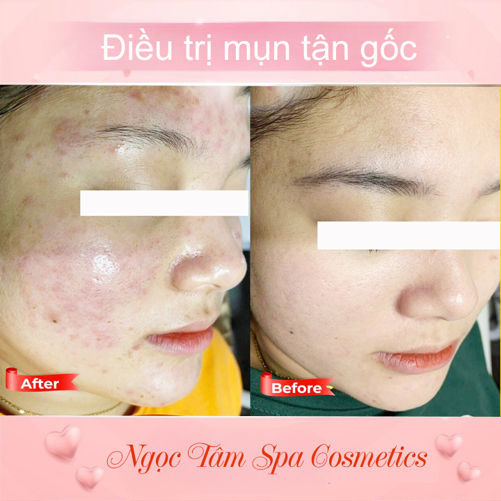 Điều-trị-Mụn-tận-gốc