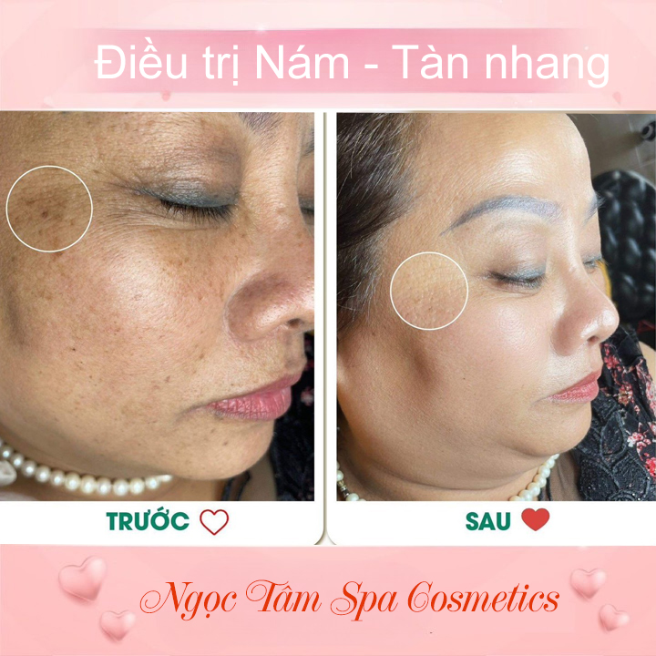 Điều-trị-Nám---Tàn-nhang