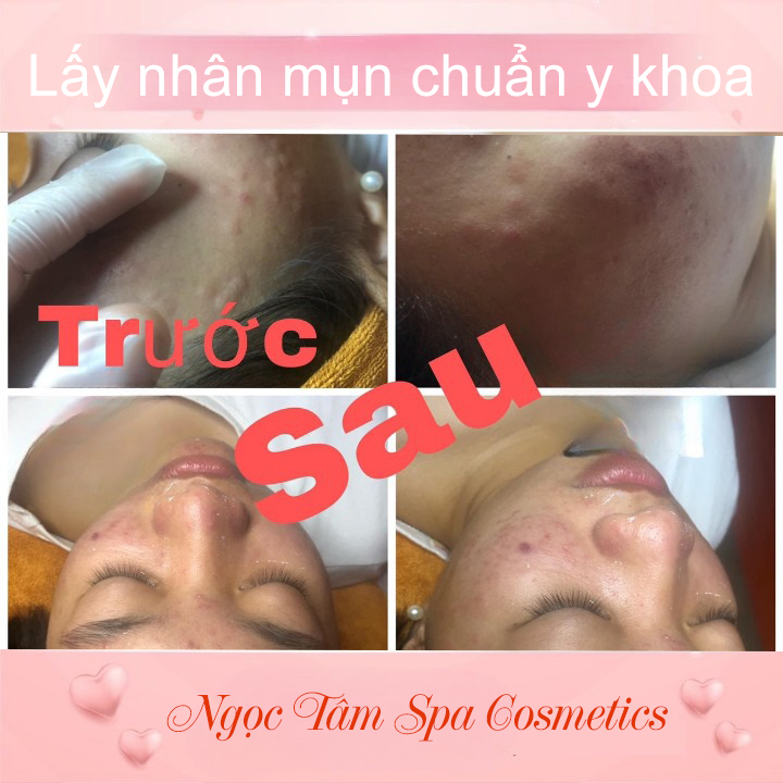 Lấy-nhân-mụn-chuẩn-y-khoa