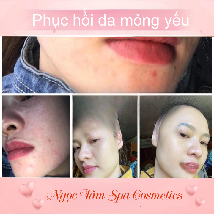 Phục-hồi-da-mỏng-yếu
