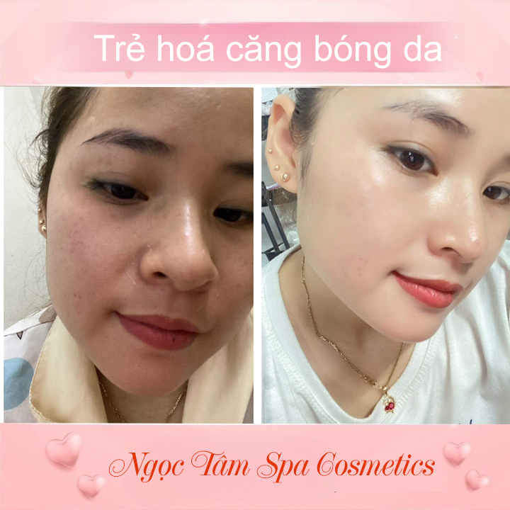 Trẻ-hoá-căng-bóng-da